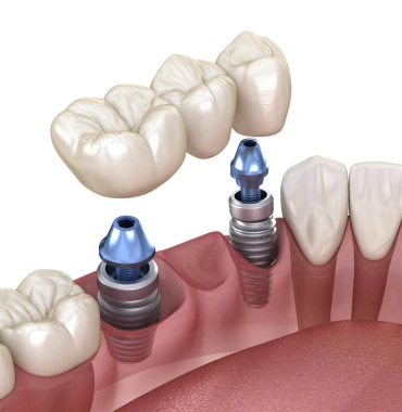 Dental Implants