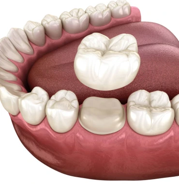 Zirconium Crowns