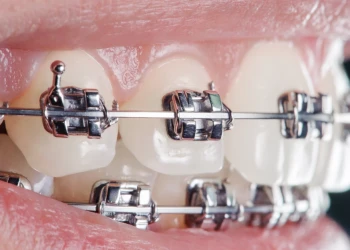 Why Celebrities Are Choosing Dental Veneers Over Braces